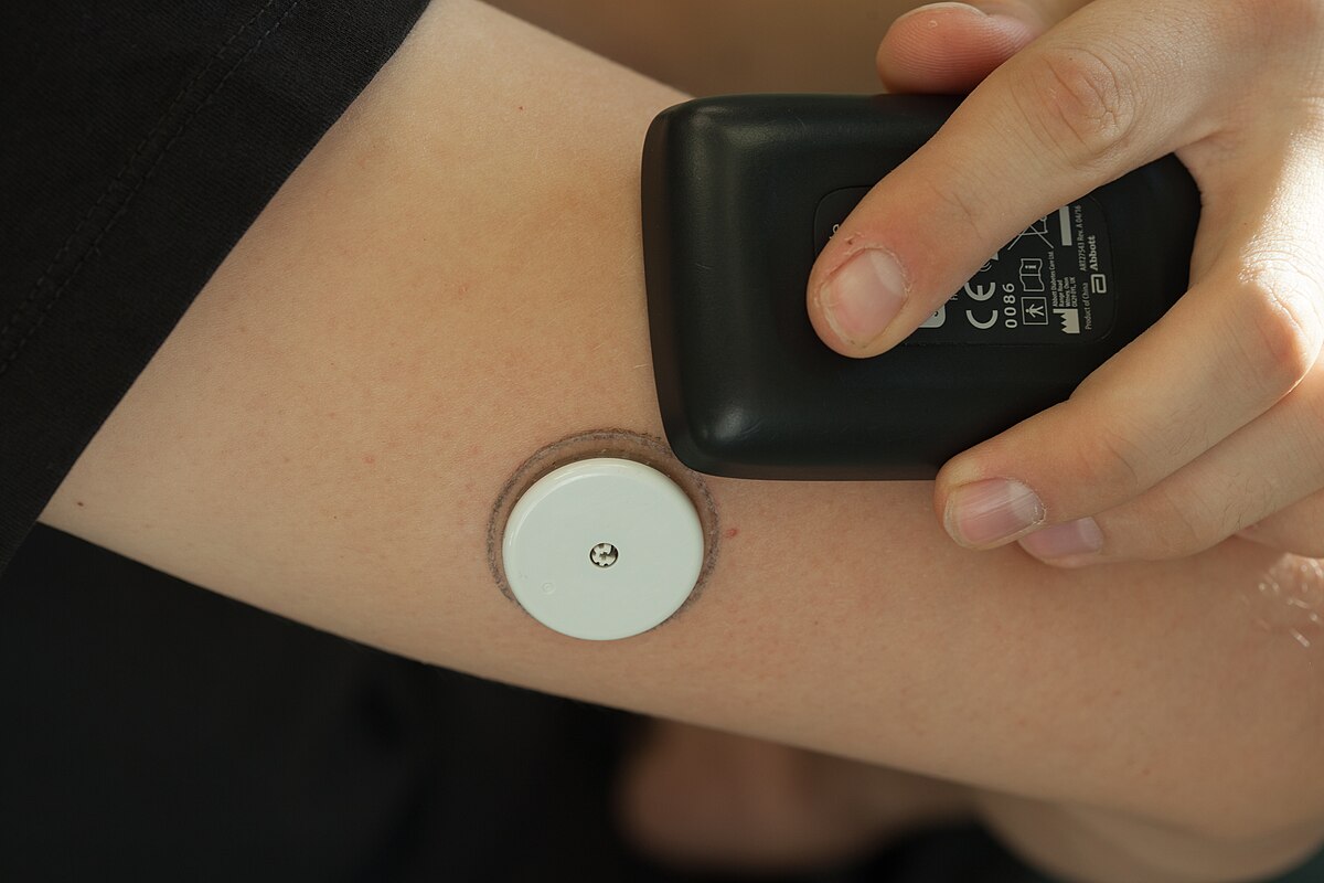 Image showing a closeup of a Continuous Glucose Sensor on the back of a person's arm