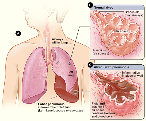 Illustration showing a comparison between normal alveoli and those with pneumonia