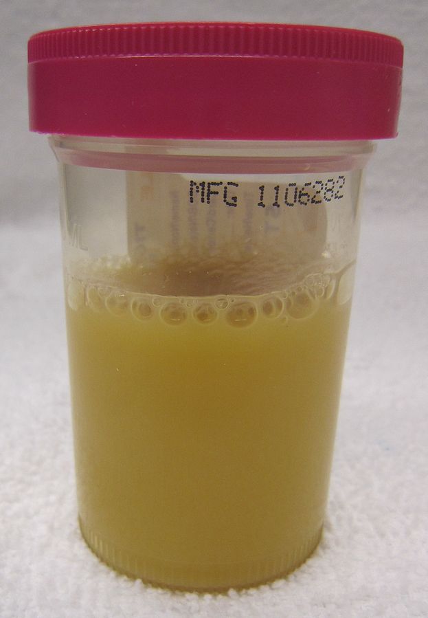 Image showing a sample bottle filled with pyuria