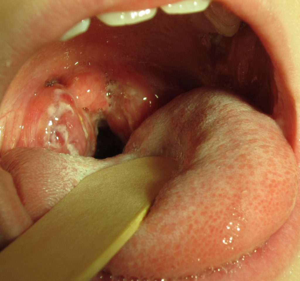 Image showing the tonsils of a patient with strep throat. Tonsils are swollen, irritated and have while spots on them.