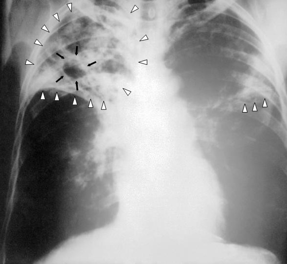 Image showing Advanced Active TB on an x-ray. White arrows indicate bilateral pulmonary infiltrate and the black arrows indicate a TB lesion called a cavitation.