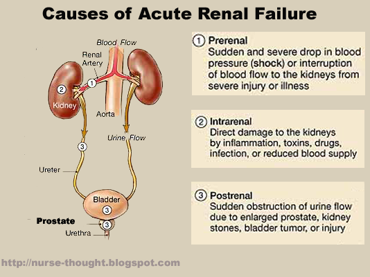 Infographic detailing causes of acute renal failure