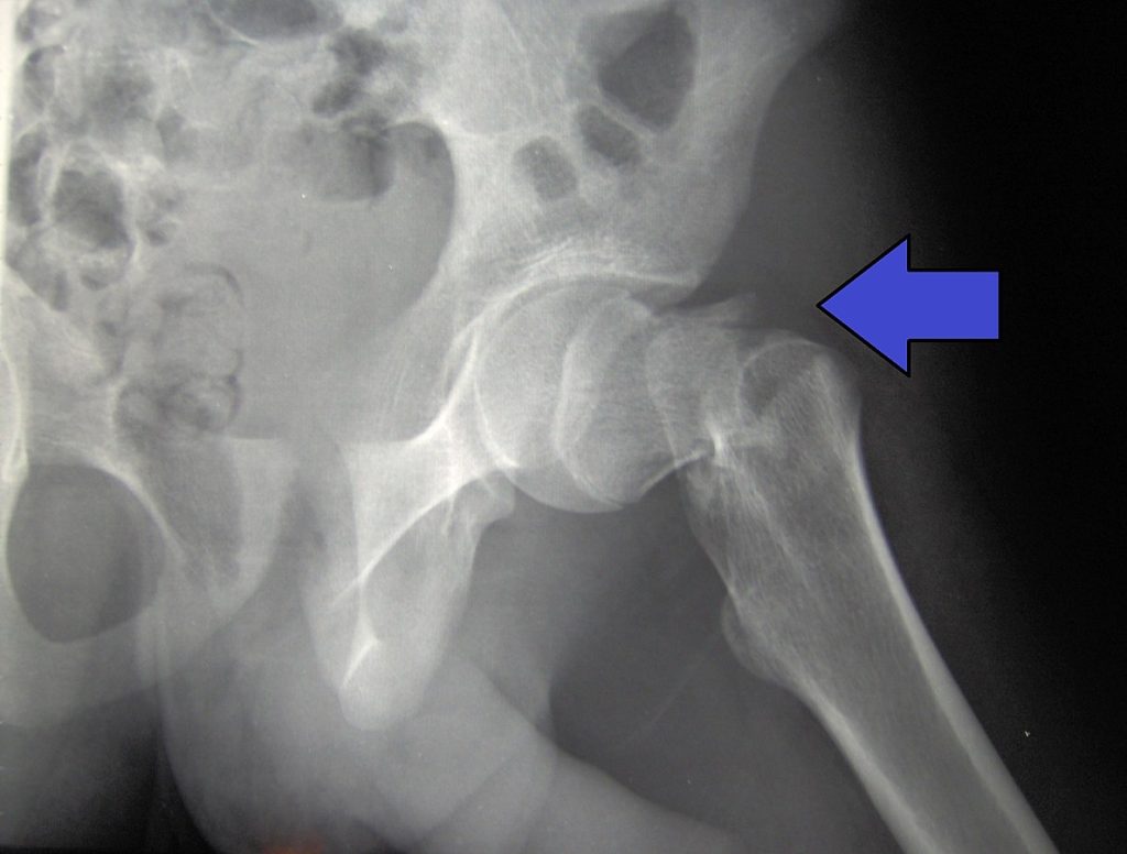 X-ray image showing a hip fracture, with arrow to indicate exact area