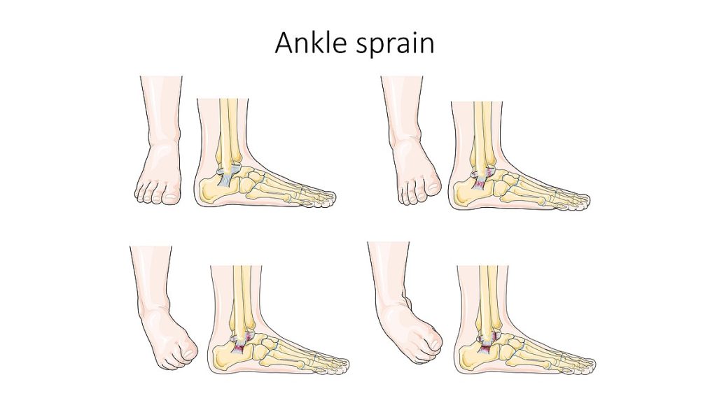 Illustration showing an ankle sprain