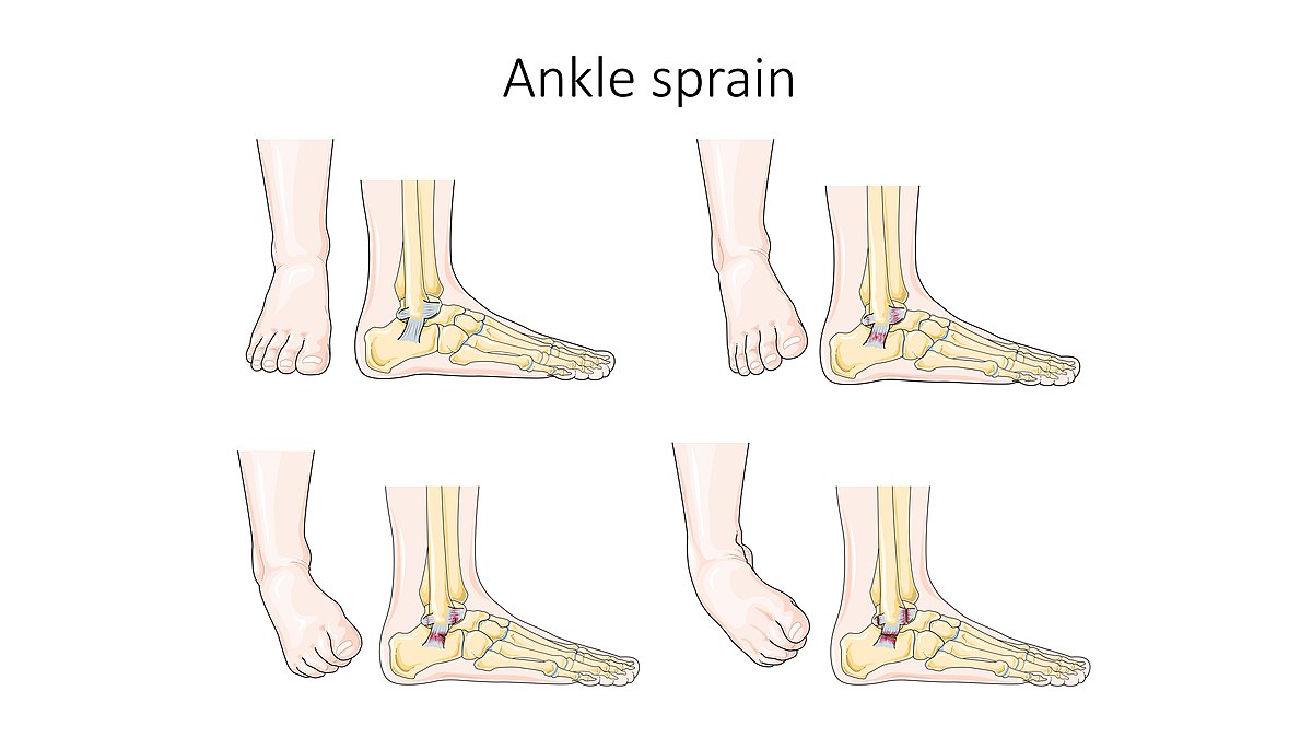 10.10 Other Musculoskeletal Disorders – Health Alterations