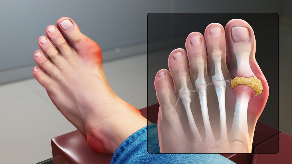 Image showing a foot with gout. along with an internal view of the tissue affected