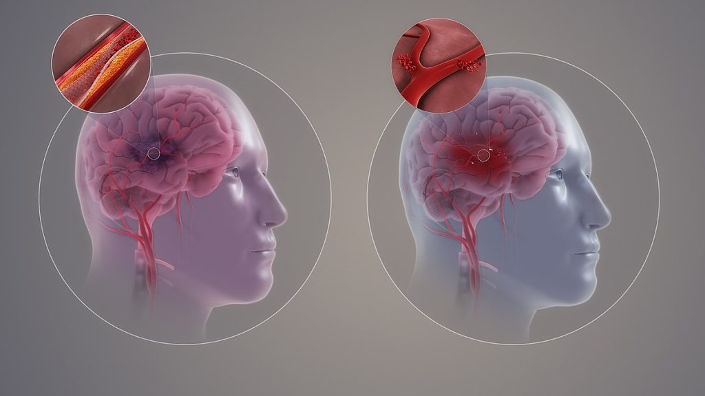 Image showing a Comparison of Ischemia and Hemorrhagic Strokes on two simulated patient brains