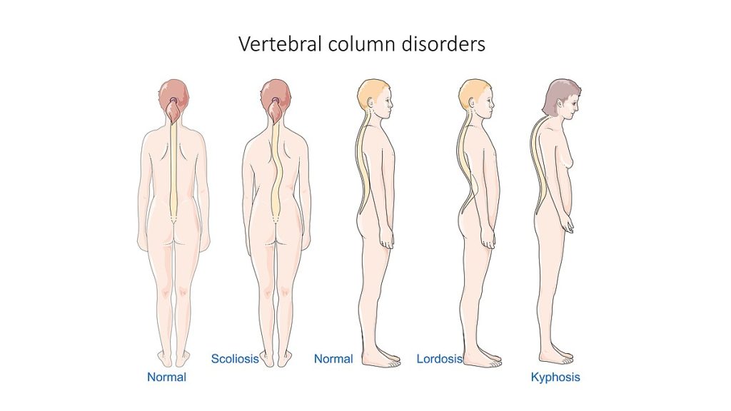 Illustration showing several Vertebral Column Disorders