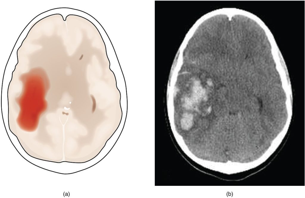 Image showing scans of a Hemorrhagic Stroke in the brain