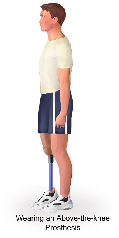 Illustration showing a person with an above the knee prosthesis