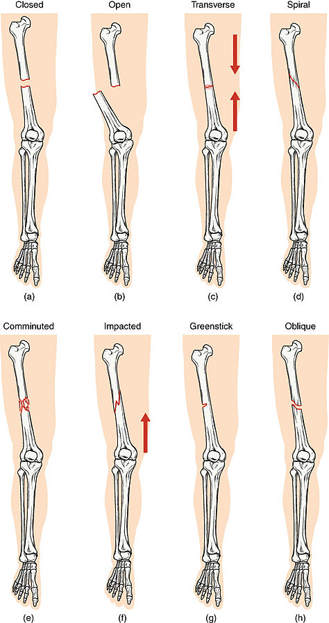 Illustration showing Types of Fractures (a) Closed; (b) Open; (c) Transverse; (d) Spiral; (e) Comminuted; (f) Impacted; (g) Greenstick; and (h) Oblique