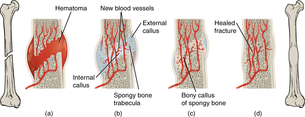 Illustration showing the stages of bone healing
