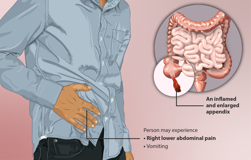 Illustration showing a personal with hand over area of appendix, indicating pain from appendicitis.  A small inset shows an internal closeup of the inflamed and enlarged appendix.