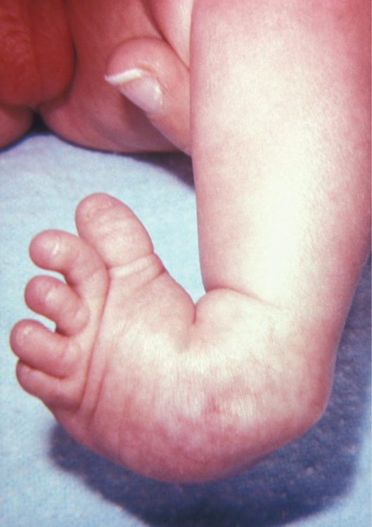 Image showing an infant with clubfoot