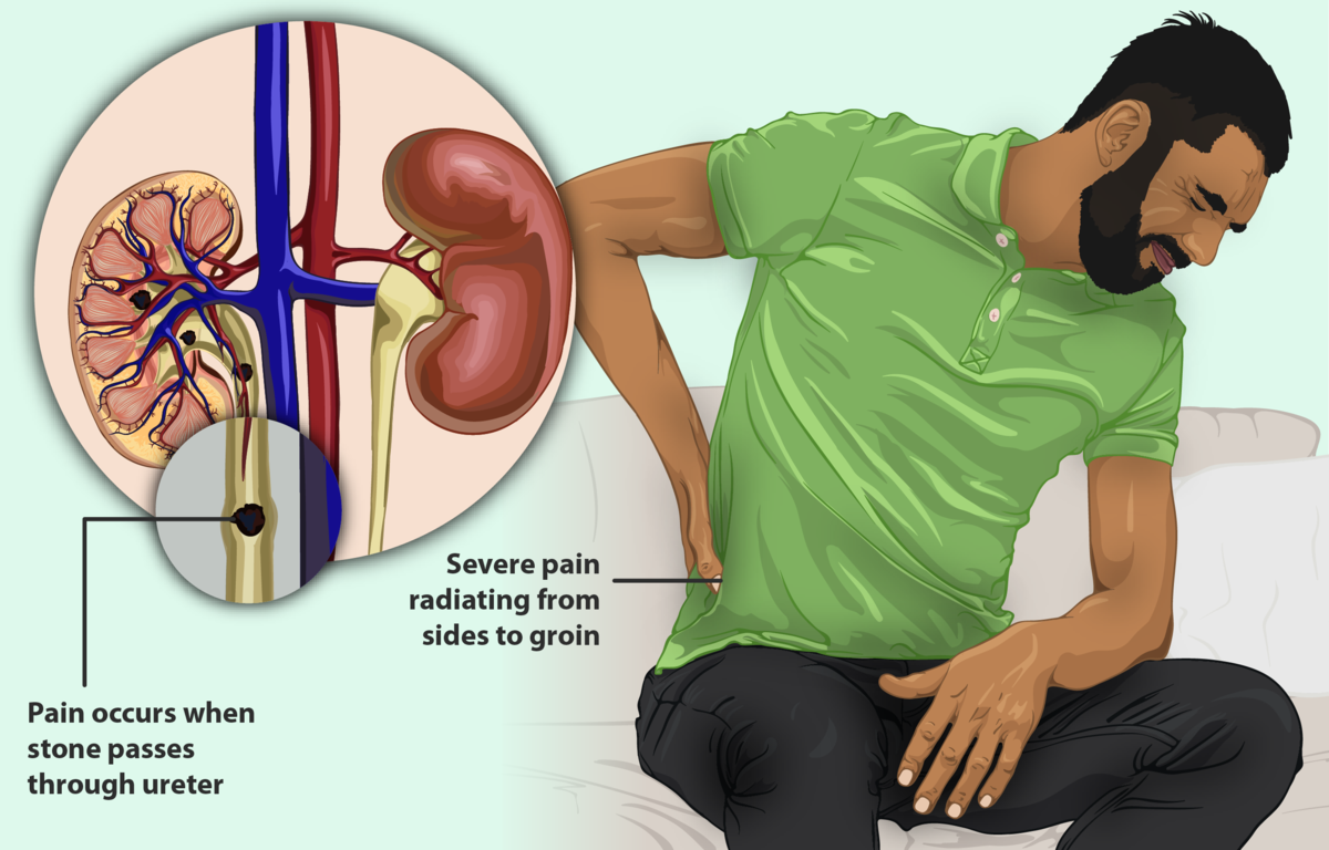 Illustration showing a person sitting and reaching back to touch lower back, as if reacting to flank pain associated with pyelonephritis. Includes closeup circle image of stone passing through urinary tract.