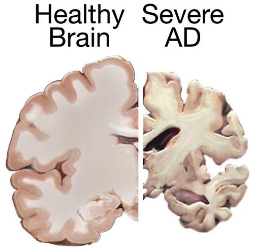 Illustration showing a Comparison of a Normal Brain and a Brain With Severe Alzheimer's Disease