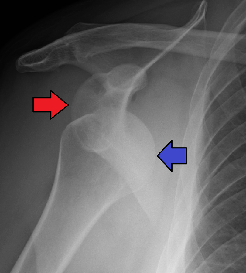 Image showing an x-ray of a dislocated shoulder with arrows indicating the placement