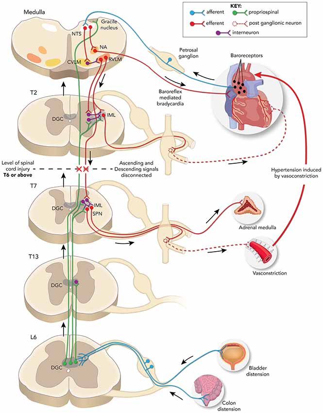 Illustration of neuronal pathways disrupted/rerouted by complete spinal cord injury above the sixth thoracic (T6) spinal level associated with the development of autonomic dysreflexia evoked by pelvic visceral distension