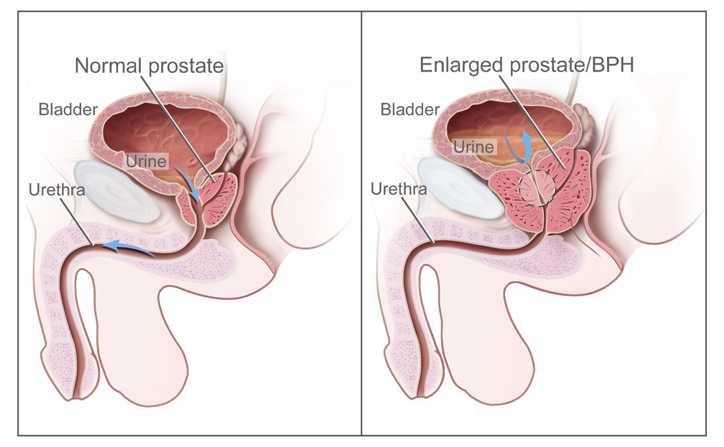 Illustration showing side by side comparison of normal prostate versus one with enlarged prostate and Benign prostatic hyperplasia