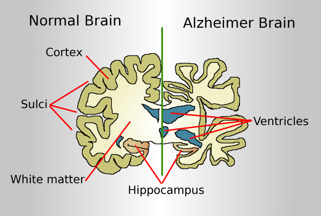 Illustration showing Structures of a Normal Brain Compared to a Brain with Alzheimer's Disease
