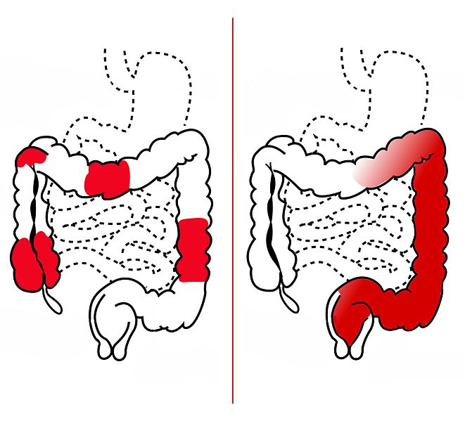 Illustration showing a Comparison of Locations of Inflammation in Crohn’s Disease (CD) and Ulcerative Colitis (UC).