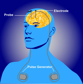 Illustration showing deep brain stimulation treatment