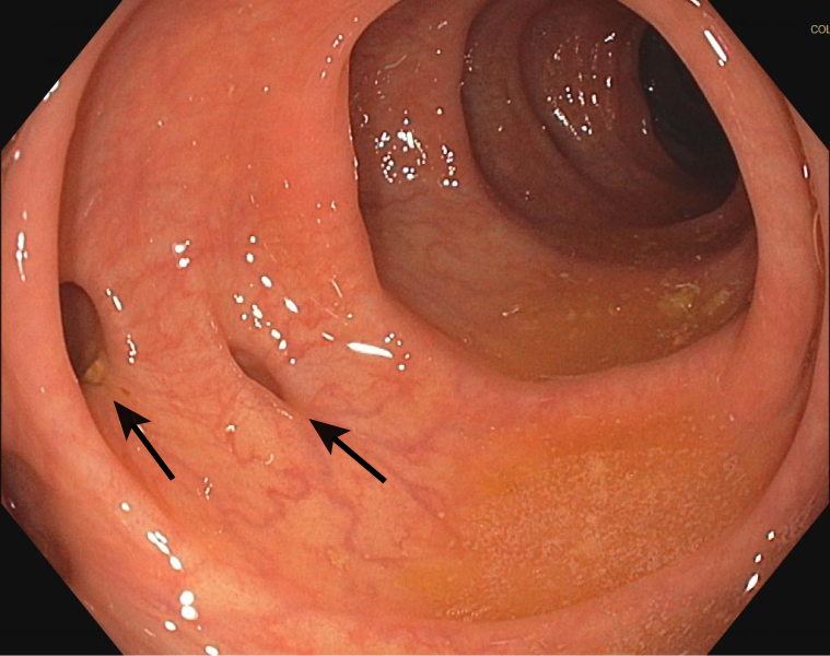 Image showing Arrows Indicating Two Diverticula on Colonoscopy
