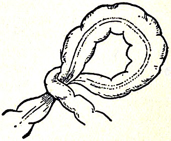 Illustration showing volvulus, otherwise known as twisting of the intestine