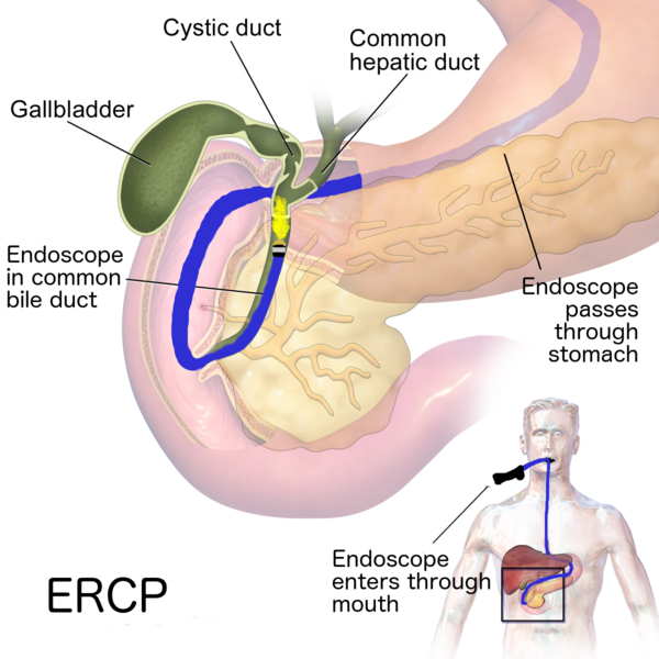 Illustration showing Endoscopic Retrograde Cholangiopancreatography (ERCP) procedure