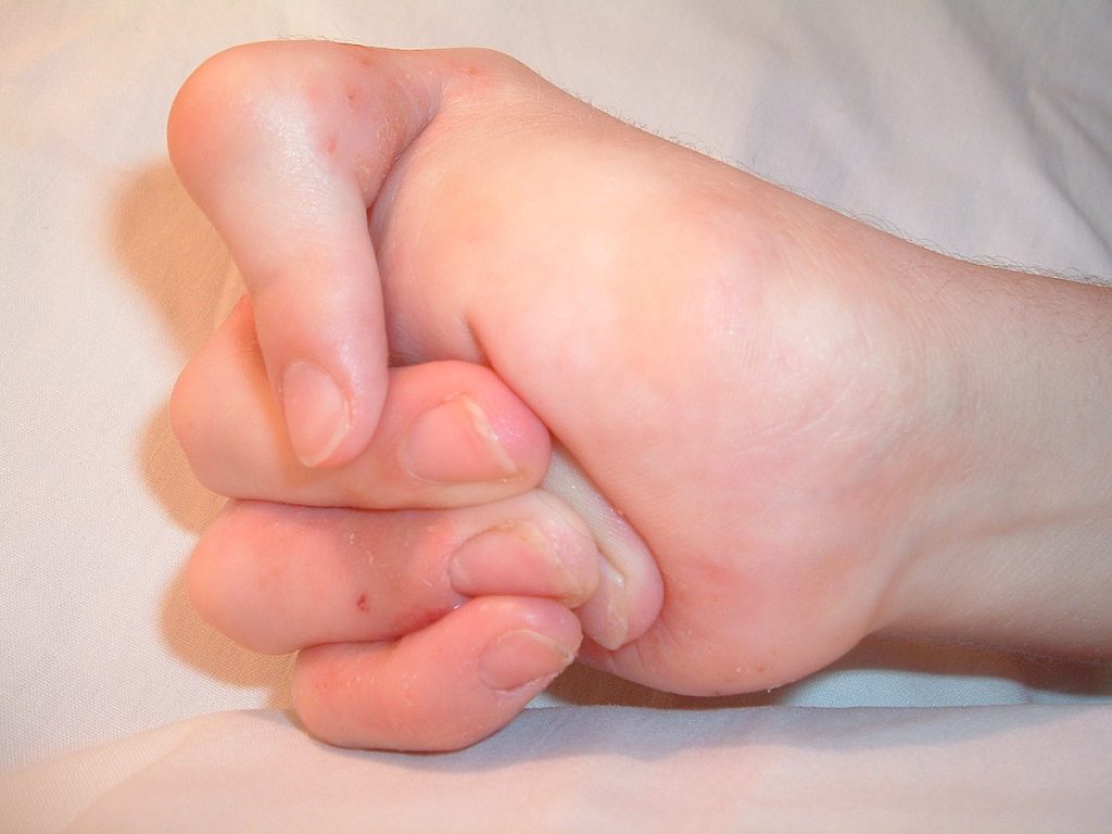 Image showing hand contracture from Freeman-Sheldon syndrome