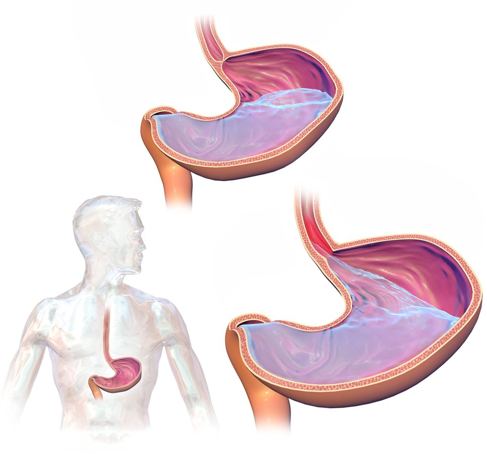 Illustration showing Backflow of Stomach Contents That Occurs With GERD