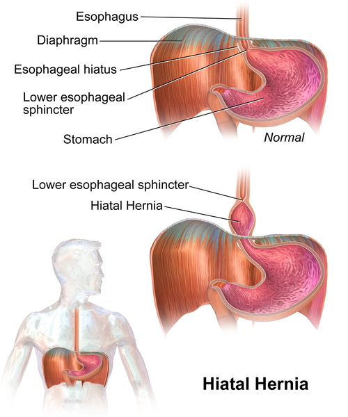 Illustration showing the location and closeup of a Hiatal Hernia with text labels for major structures