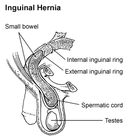 Illustration showing a Inguinal Hernia with text labels for major structures