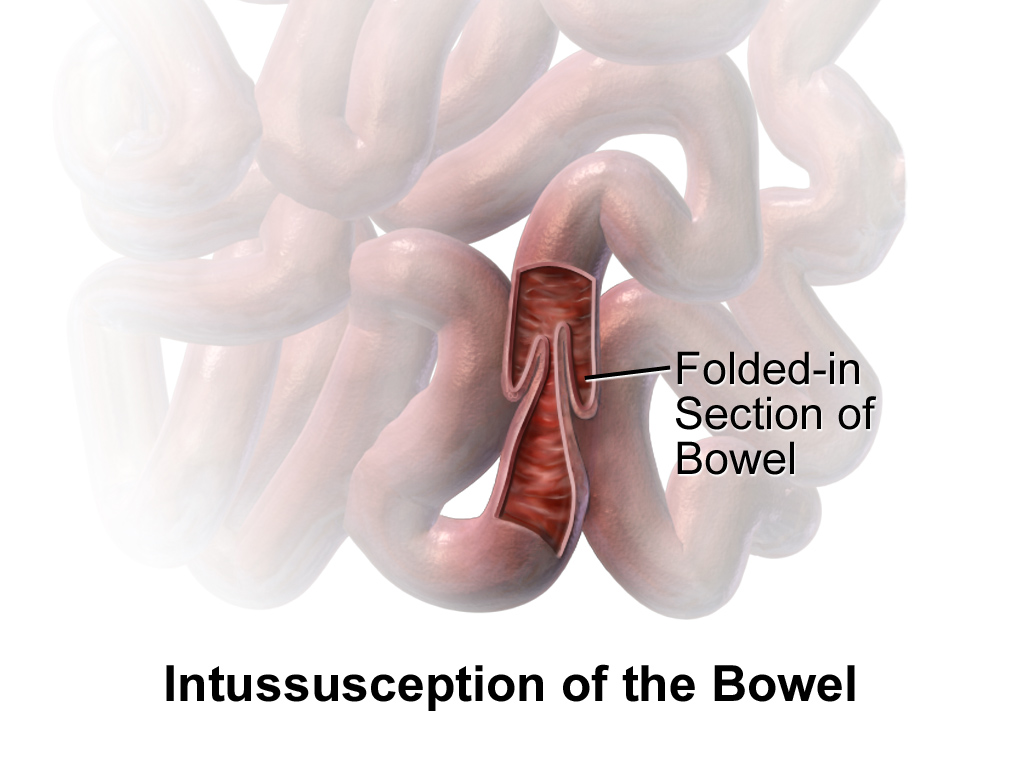 Illustration showing intussusception of the bowel