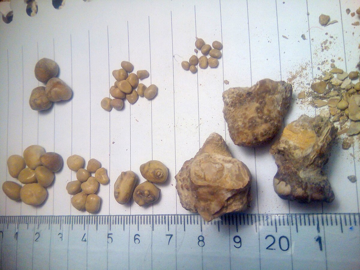 Image showing renal calculi on a lined surface with a ruler on the bottom edge to demonstrate various sizes of the calculi