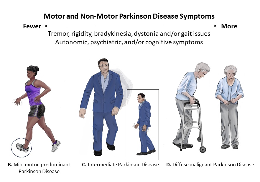 Illustration showing spectrum of Common Postures Associated with the Stages of Parkinson’s Disease