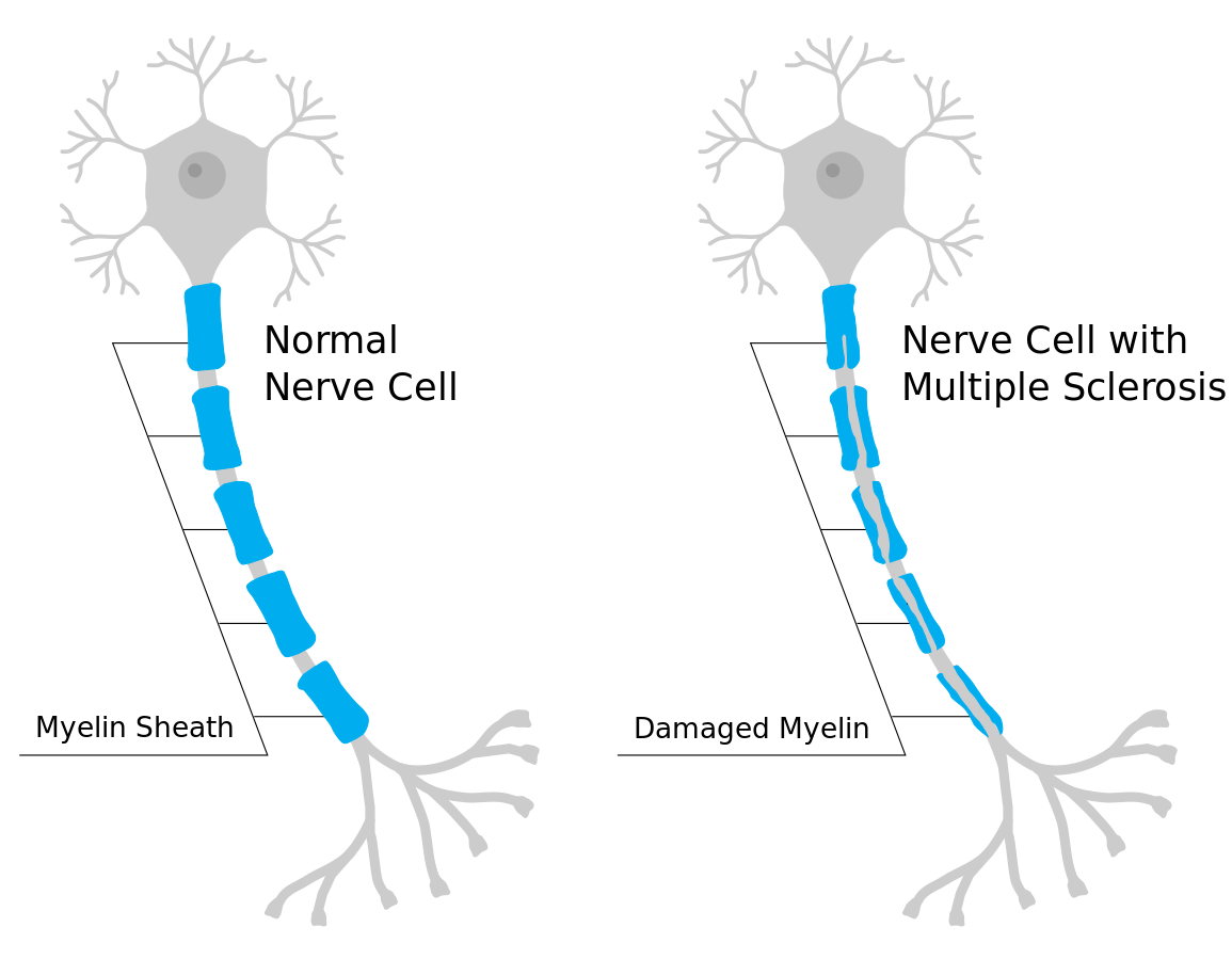 Illustration showing a comparison of a normal nerve cell and nerve cell with multiple sclerosis that has a damaged myelin sheath