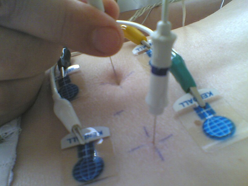 Image showing Needle EMG of Paravertebral Muscles