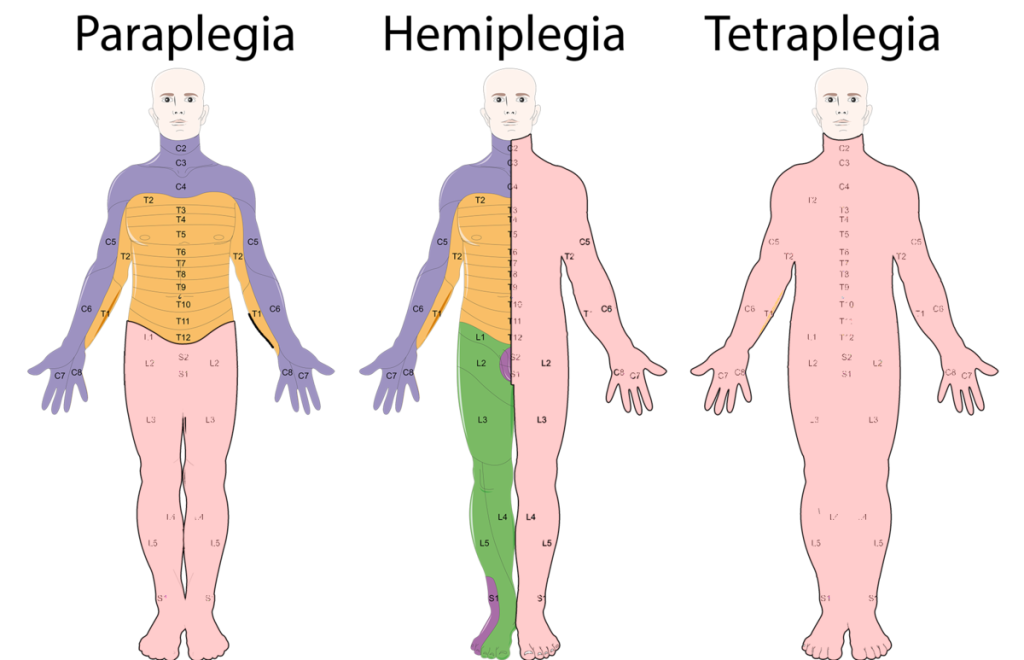 Illustration showing Paraplegia, Hemiplegia, and Tetraplegia (Quadriplegia) areas of impact on three human forms