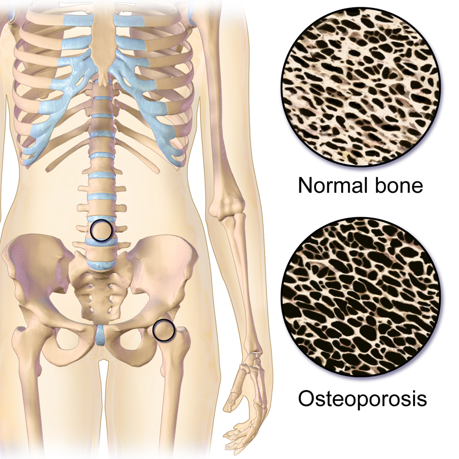 Illustration showing Osteoporosis in the Hip and Spine with closeup views of normal and osteoporosis ridden bone