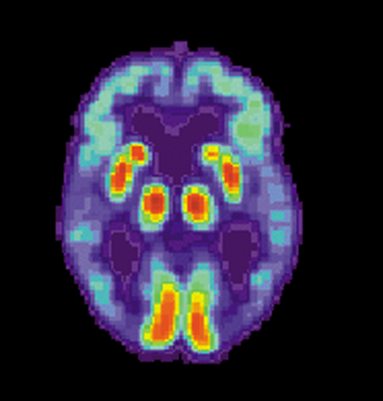 Image showing a PET Scan of a Brain with Alzheimer's Disease