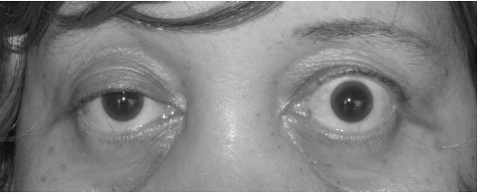 Image showing the eyes of someone with ptosis related to Myasthenia gravis