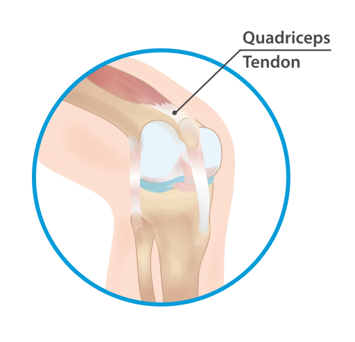 Illustration showing a closeup of a tendon in the knee