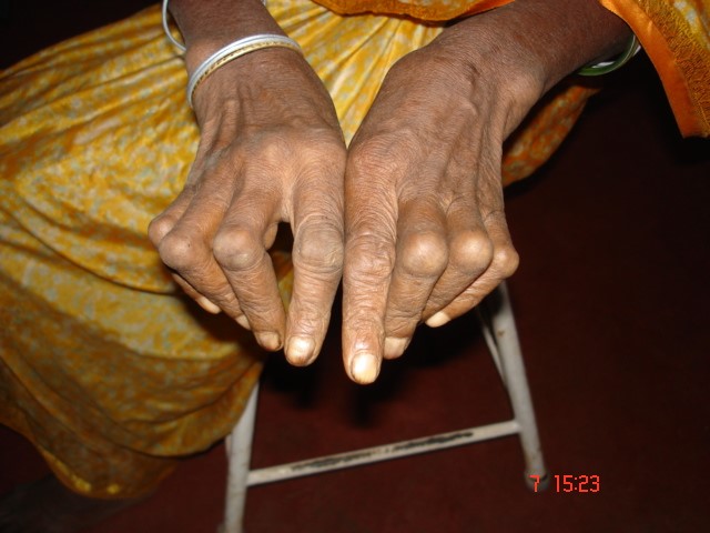 Image showing a person with Boutonniere Deformities on their hands