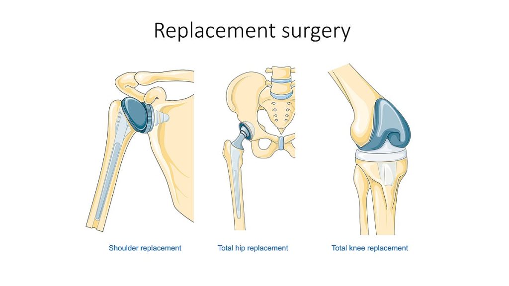 Illustration showing Joint Replacement Surgery replacement parts in their respective spots
