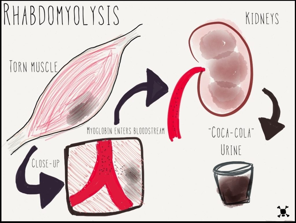 Illustration showing process of rhabdomyolysis
