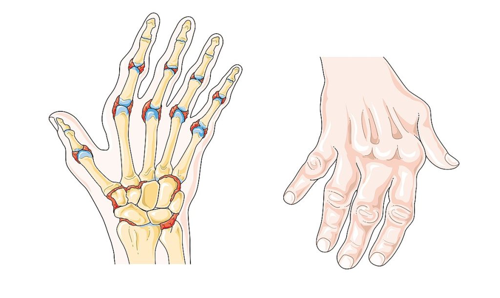 Illustration showing Swan-like Deformity of the Hands in RA