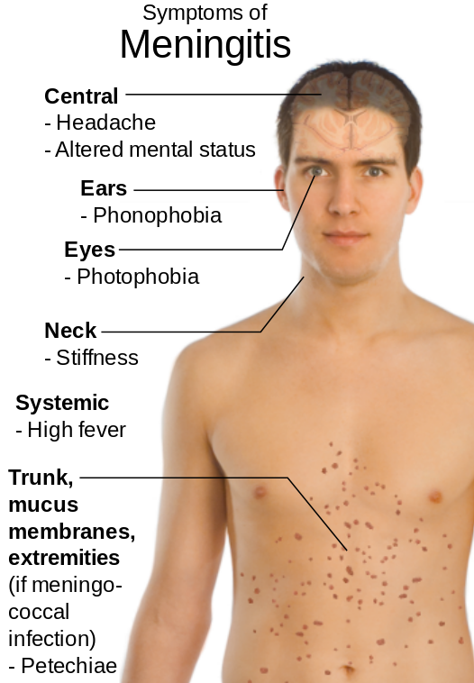 Image showing a human male with text labels to indicate Signs and Symptoms of Meningitis
