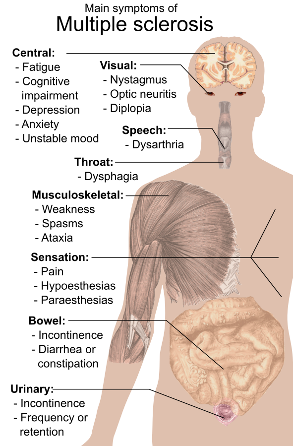 Illustration showing a human head, arm and torso with text labels indicating main symptoms of multiple sclerosis