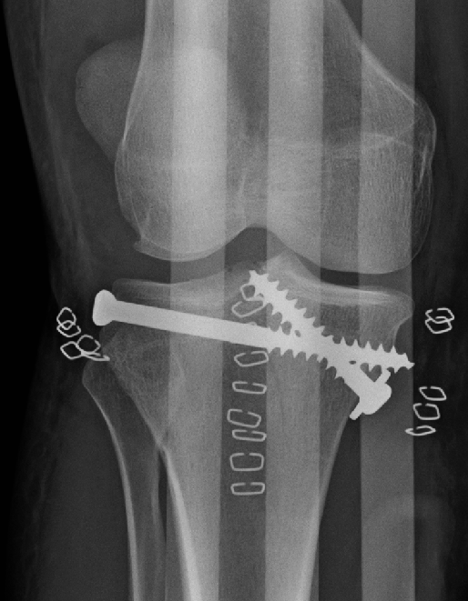 Image showing a Open Reduction and Internal Fixation (ORIF) on a patient's tibia